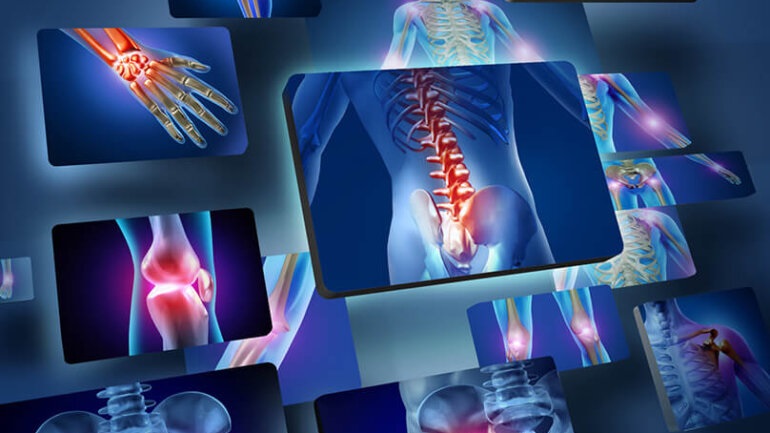 Κατάκοιτος λόγω νευροεκφυλιστικής πάθησης, περπάτησε χάρη σε ηλεκτρονικό εμφύτευμα